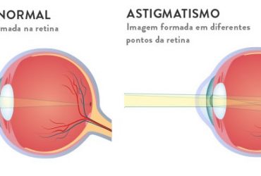 O que é Astigmatismo?